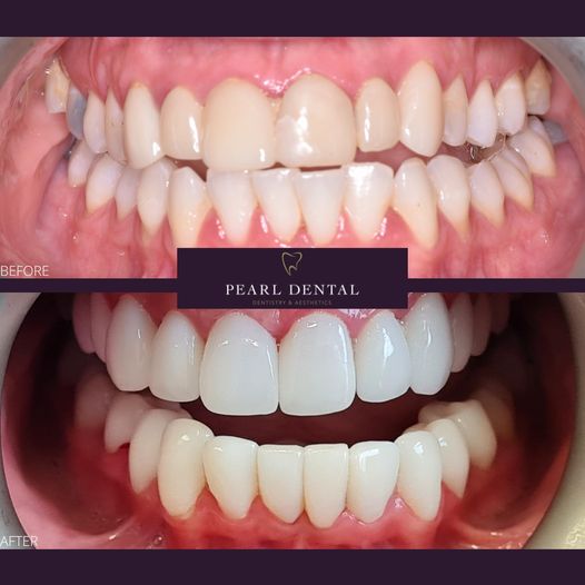 Composite Bonding before and after