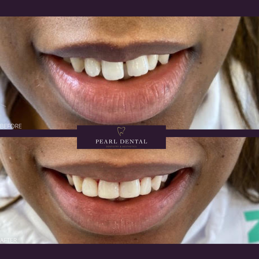 Composite Bonding at Pearl Dental